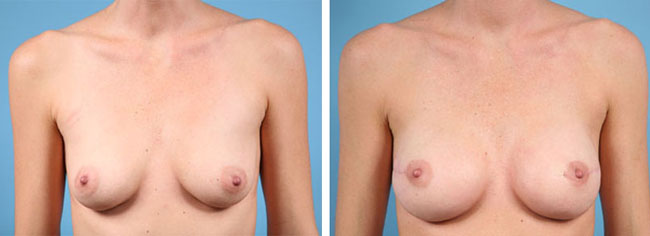 bilateral reconstruction with 325cc Moderate Plus Silicone Gel Implants
