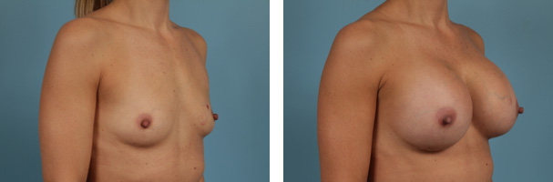Breast reconstruction before and after