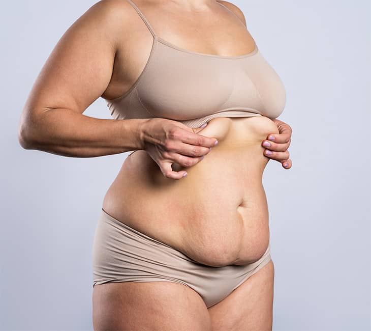 Womans Belly Tummy Tuck flabby skin Female Body Abdomen. Alcohol
