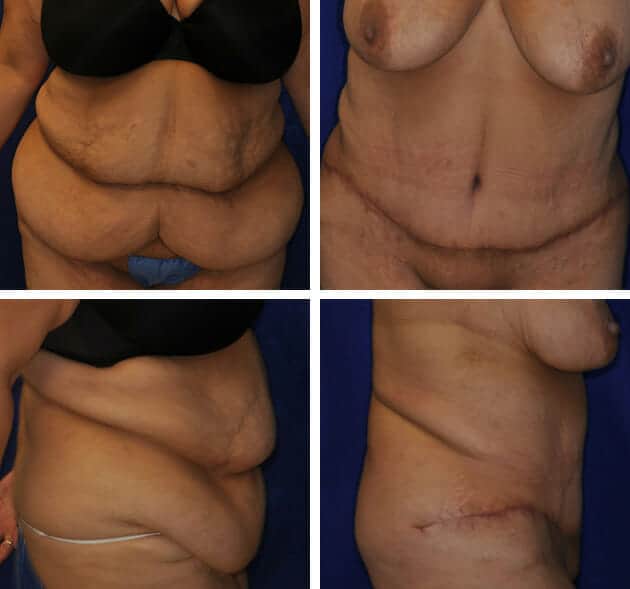 How can I expect my belly to look after a tummy tuck? - Dr. Ali Totonchi