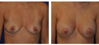 Before and After Breast Augmentation with Implants in Cleveland, OH