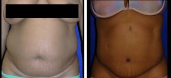 Westlake, OH Tummy Tuck before and after abdominoplasty in Cleveland
