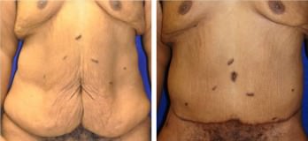 Patient before & after tummy tuck (abdominoplasty) in Cleveland, OH