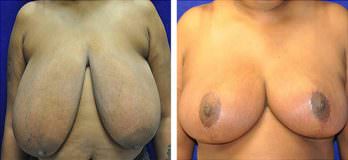 Cleveland, OH breast reduction patient before and after mammoplasty