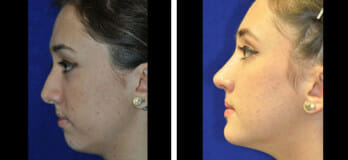 Patient before & after rhinoplasty in Cleveland, OH