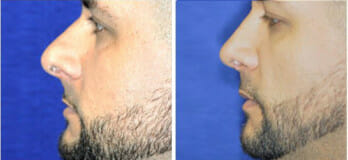 Male nose surgery patient, Westlake OH