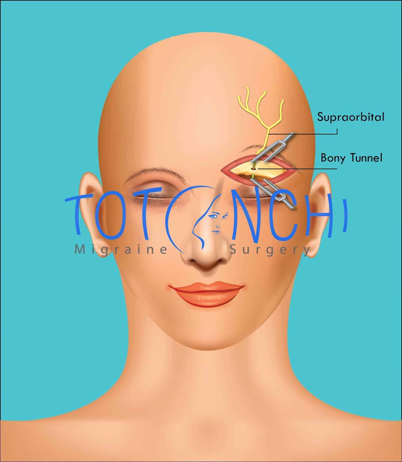 Migraine Surgery in Cleveland