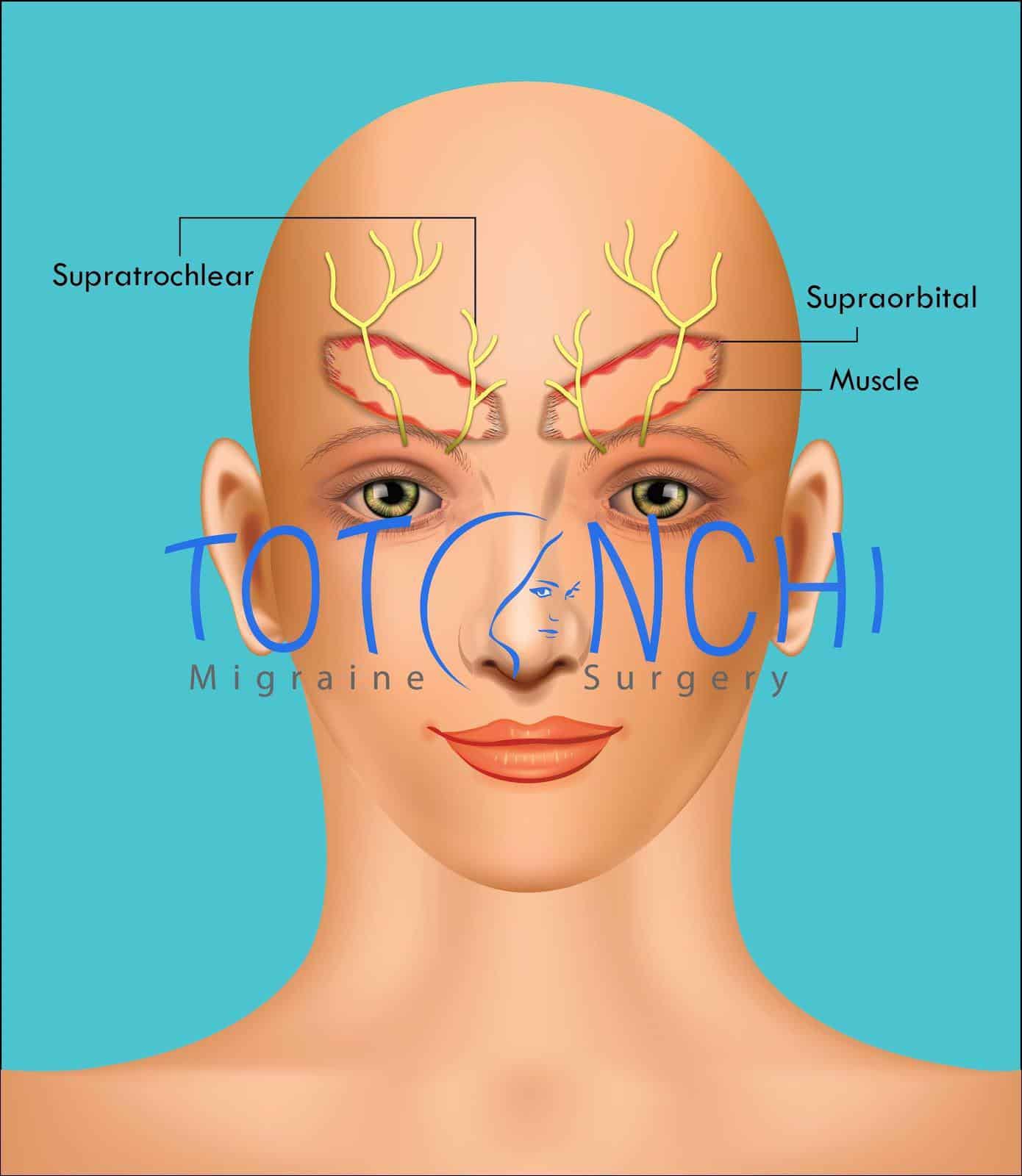 Frontal Trigger Point Surgery Diagram