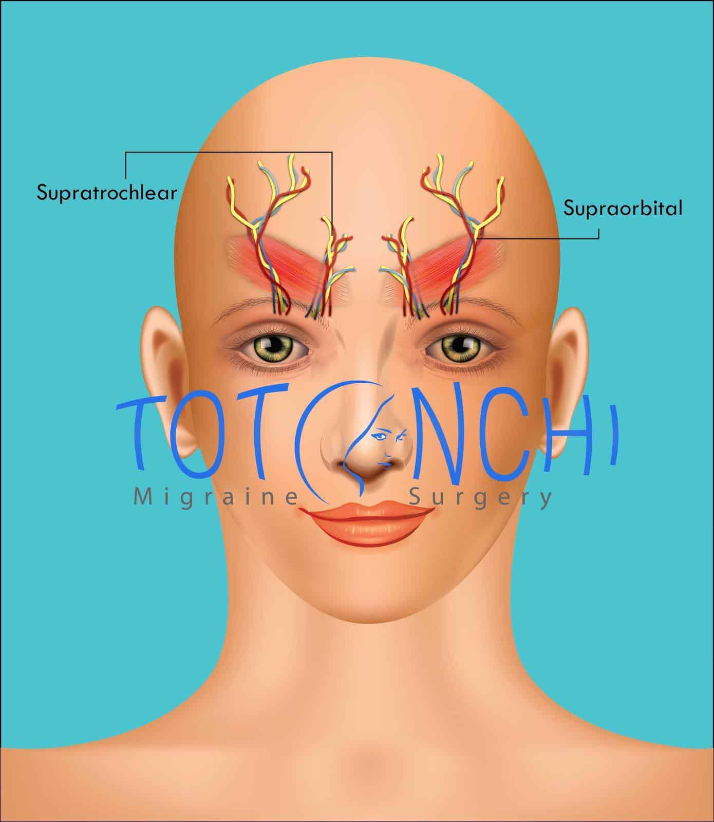 Frontal Trigger Point Migraine Surgery - Eyebrow Trigger Point