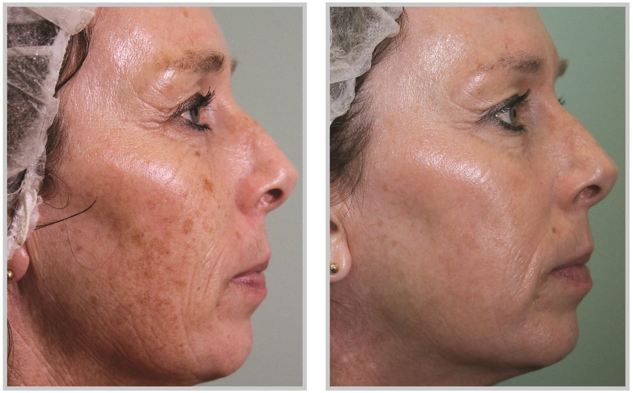 BBL Skin Treatment Cleveland - Rosacea Light Treatment