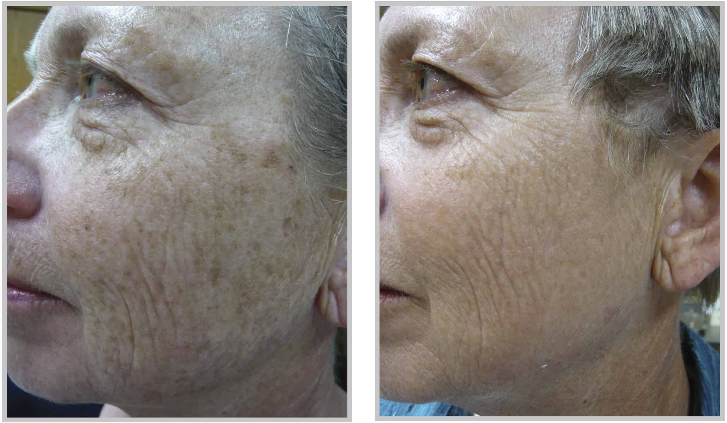 BBL Skin Treatment Cleveland -