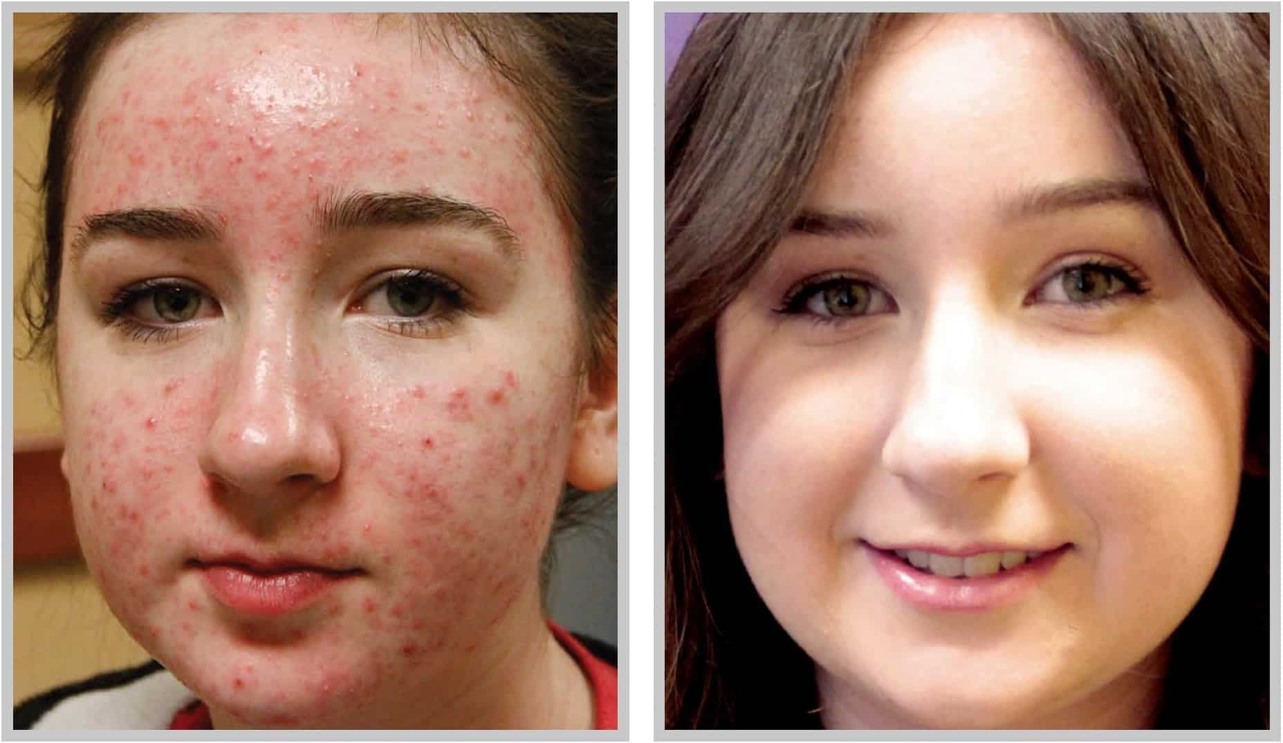 Actual BBL Acne Treatment Patient in Cleveland