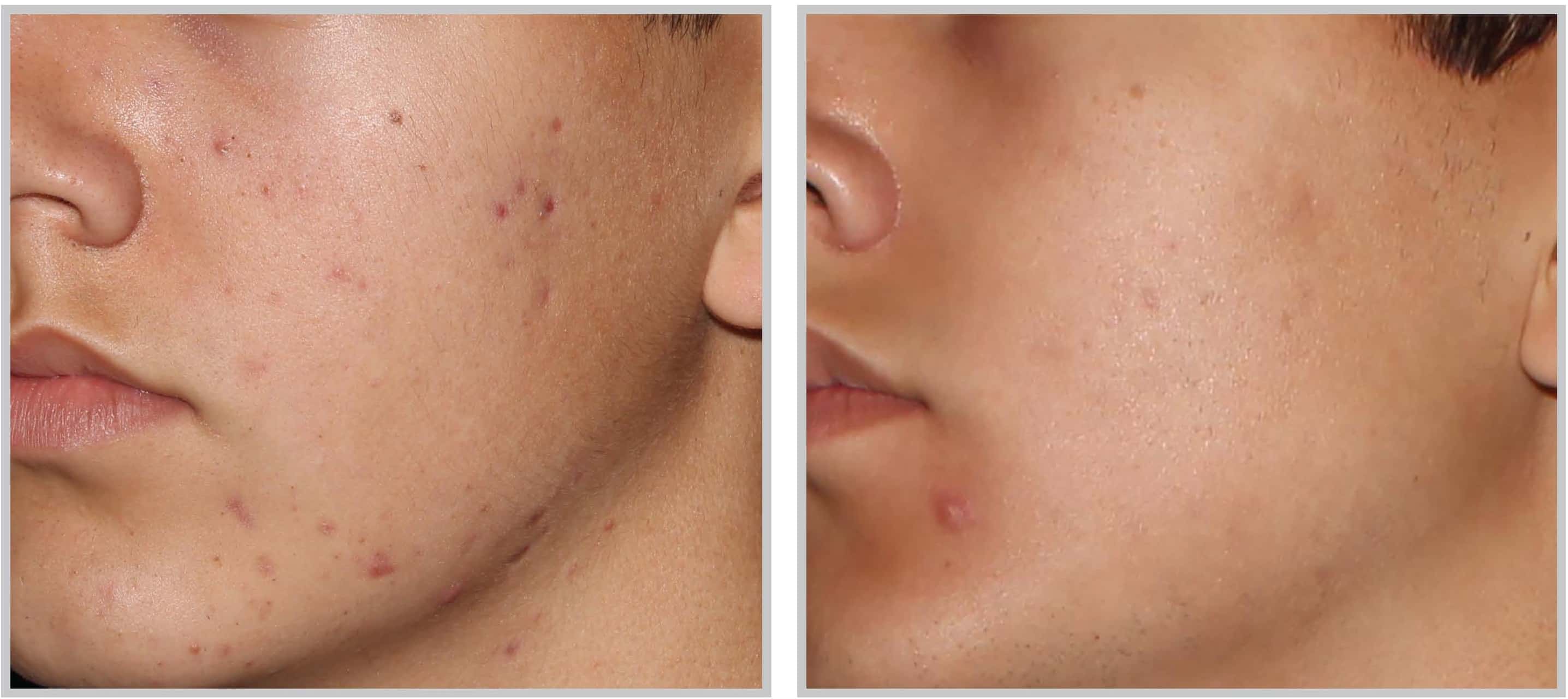 Cleveland Patient before & after BBL Acne Treatment