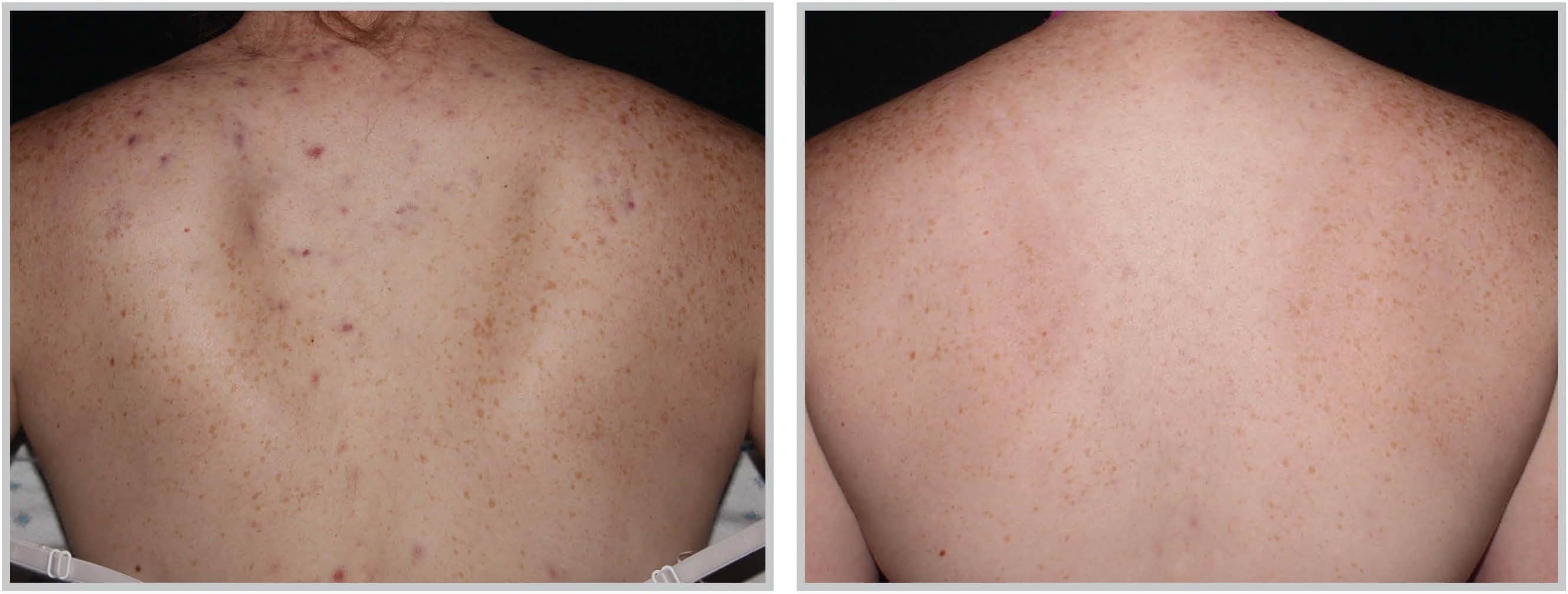 BBL Light Acne Treatment in Cleveland