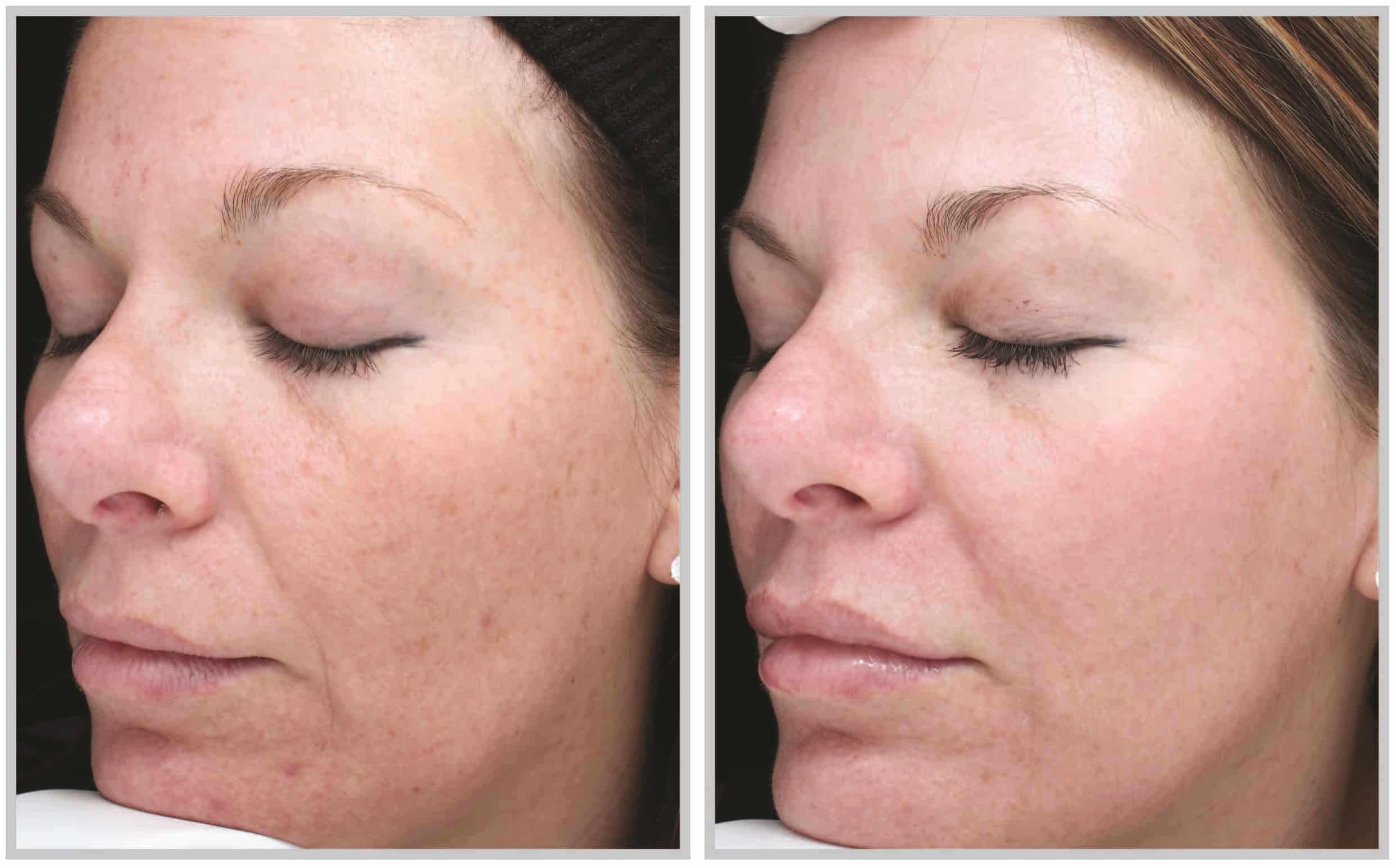 Cleveland patient before and after Halo Skin Rejuvenation