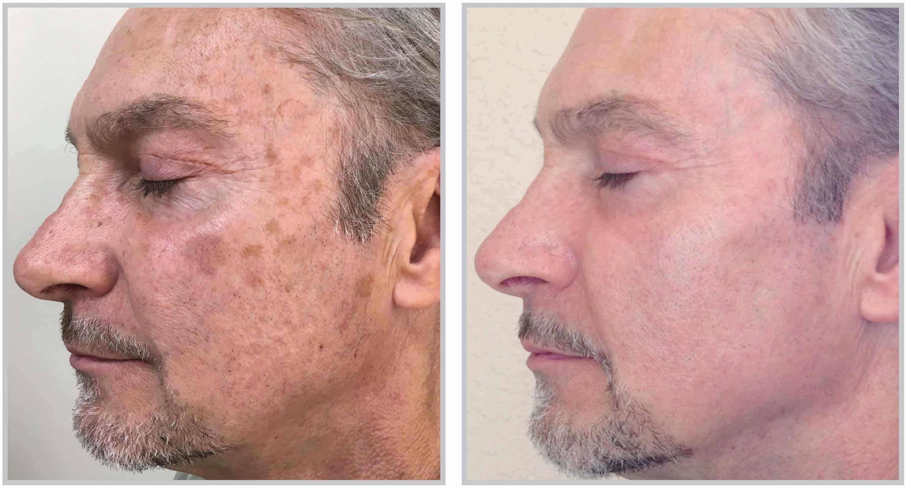 Cleveland Halo Skin Rejuvenation patient before and after
