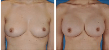 Cleveland Breast Augmentation Patient before & after