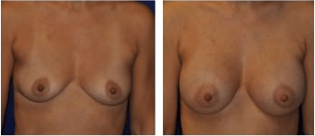 Breast Augmentation Cleveland, OH Patient