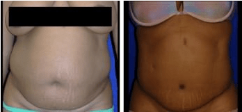 Tummy Tuck in Cleveland Ohio