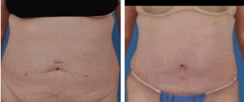 Cleveland Tummy Tuck Patient before & after