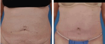 Liposuction in Cleveland, OH