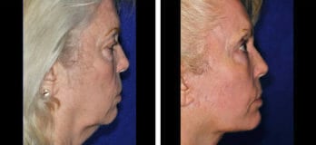 Neck Lift Patients in Cleveland