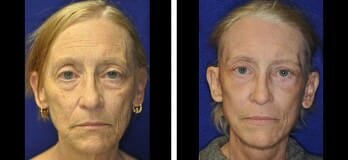 Patient Before & After Facelift in Cleveland, OH