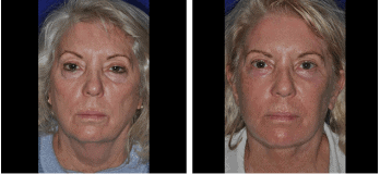 Cleveland Facelift Patient Before & After Photos