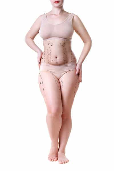 Will I Have Scarring after Tummy Tuck?