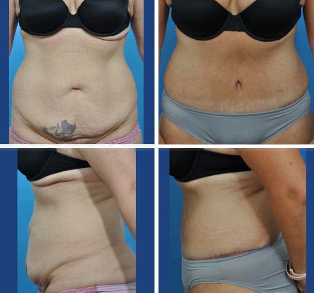 How can I expect my belly to look after a tummy tuck? - Dr. Ali Totonchi