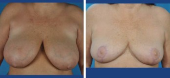 breast lift Before after
