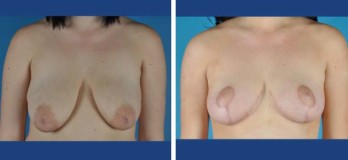 Before an after breast lift
