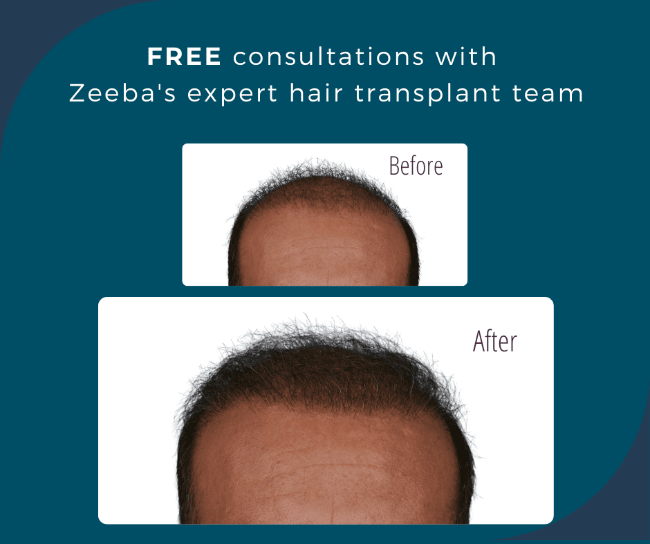 Hair Transplant Treatments In Cleveland - Totonchi Plastic Surgery