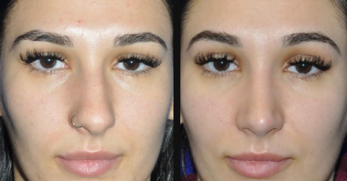 Rhinoplasty Before and After