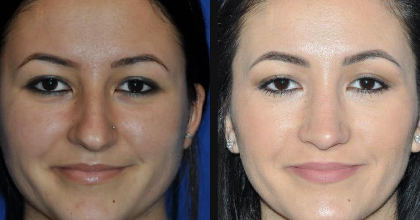 Rhinoplasty Before and After