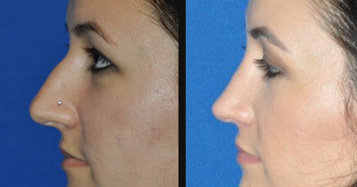 Rhinoplasty Before and After