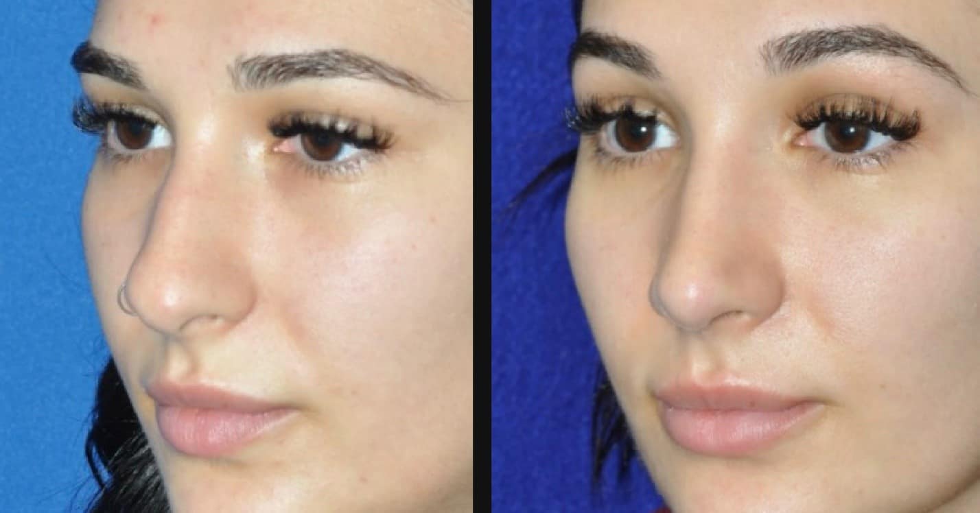 Rhinoplasty Before and After
