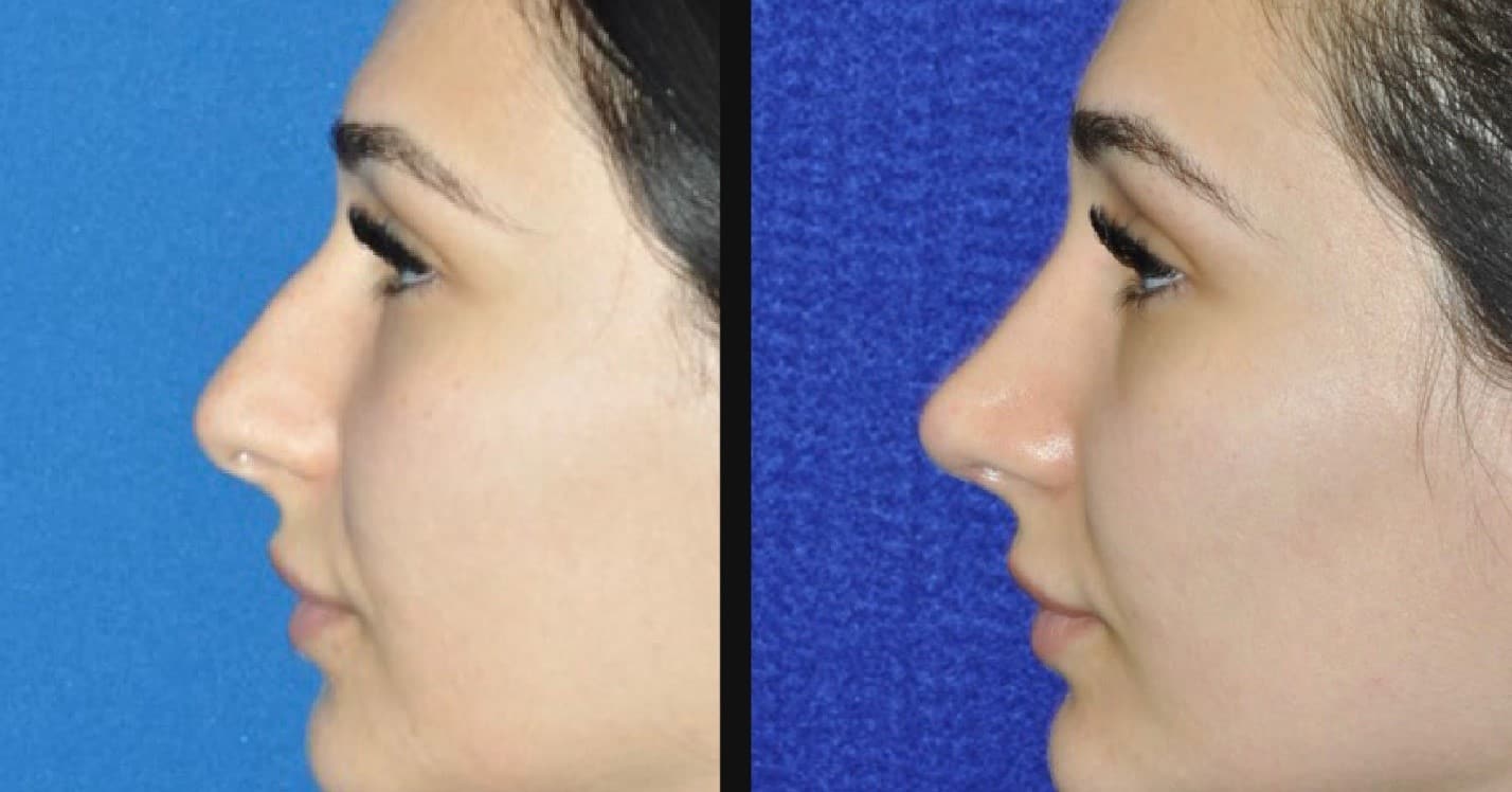 Rhinoplasty Before and After