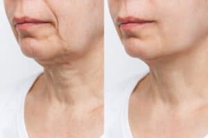 Male and Female Neck Lift Service in Cleveland