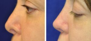revision rhinoplasty