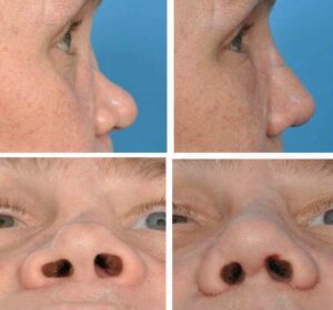 revision rhinoplasty