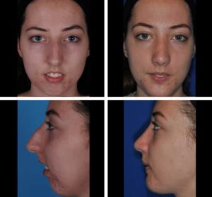 revision rhinoplasty