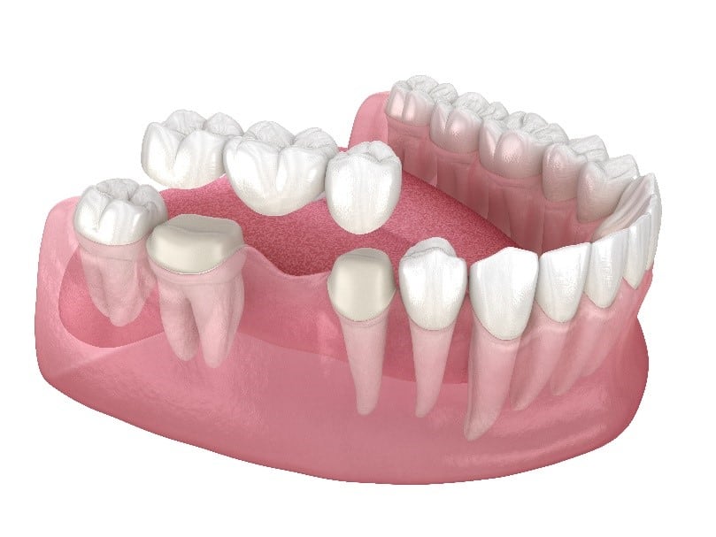 Dental Restoration Crowns Mission Viejo