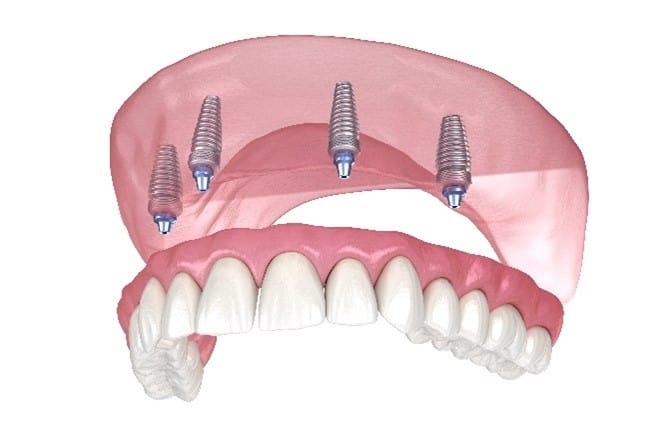 All on 4 Dental Implants Mission Viejo