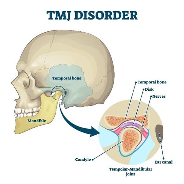 TMJ Treatment Mission Viejo