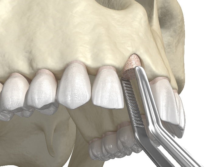 Bone Grafting Mission Viejo