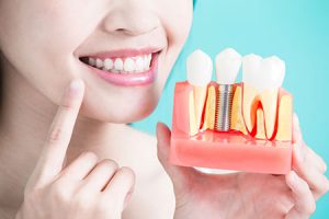 Implant Dentistry in Mission Viejo
