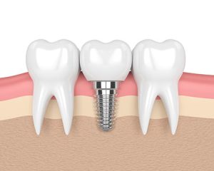 Mission Viejo Implant Dentist