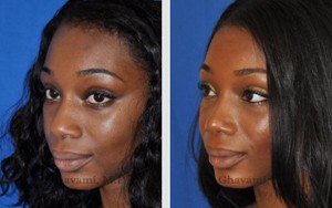 African American Rhinoplasty - Beverly Hills Rhinoplasty