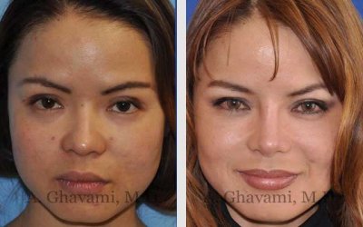 asian nose job before and after